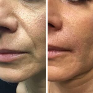 botok-before-after-2