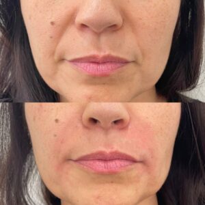 botok-before-after-4