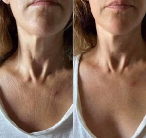 botok-before-after-5